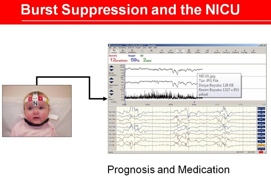 Nicolet Brain Monitor