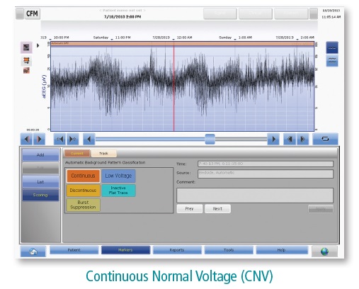 Olympic BrainZ CFM - aEEG - Amplitüde Integrated EEG