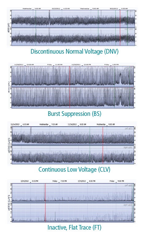 Olympic BrainZ CFM - aEEG - Amplitüde Integrated EEG