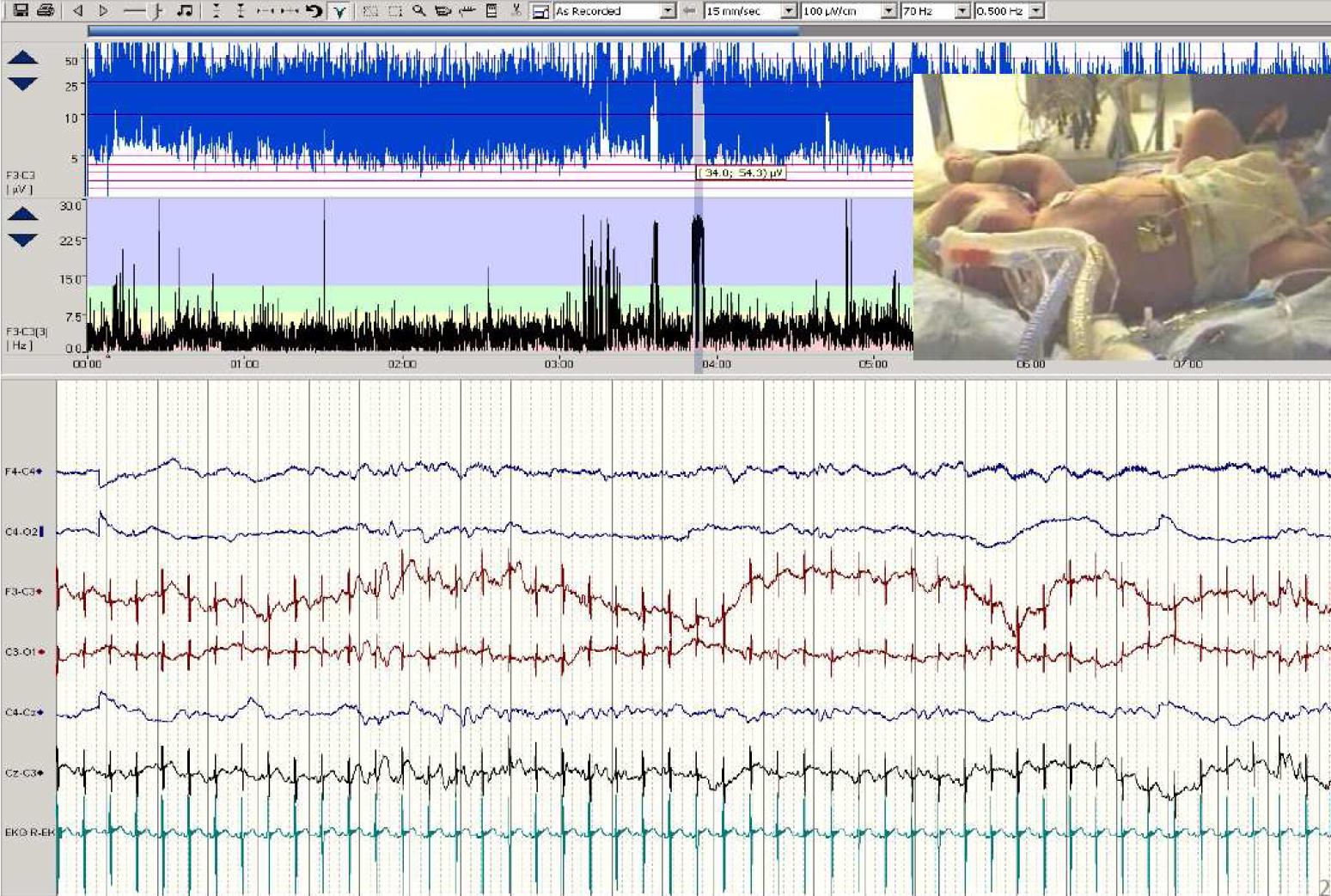    Rutin EEG Cihazı - Video EEG